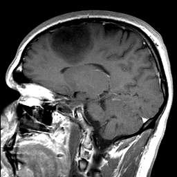 MRI of the brain; dark contrast shows a tumour